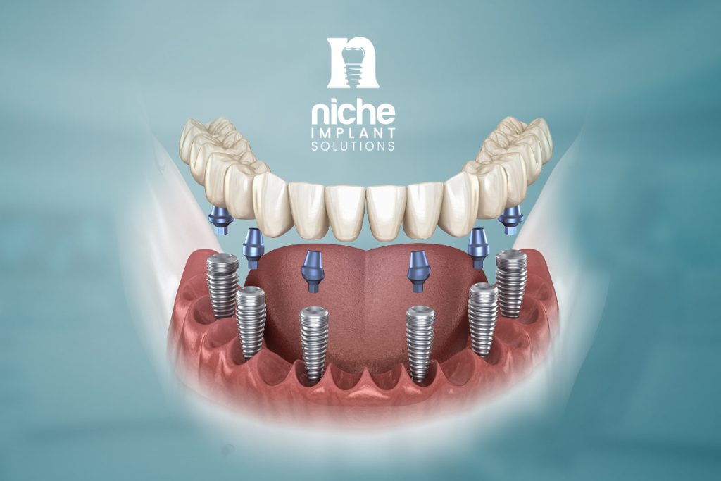 prosthetic screw implant