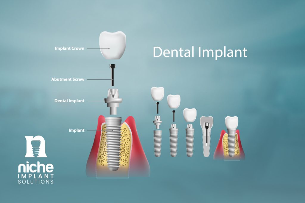 best dental implant brands