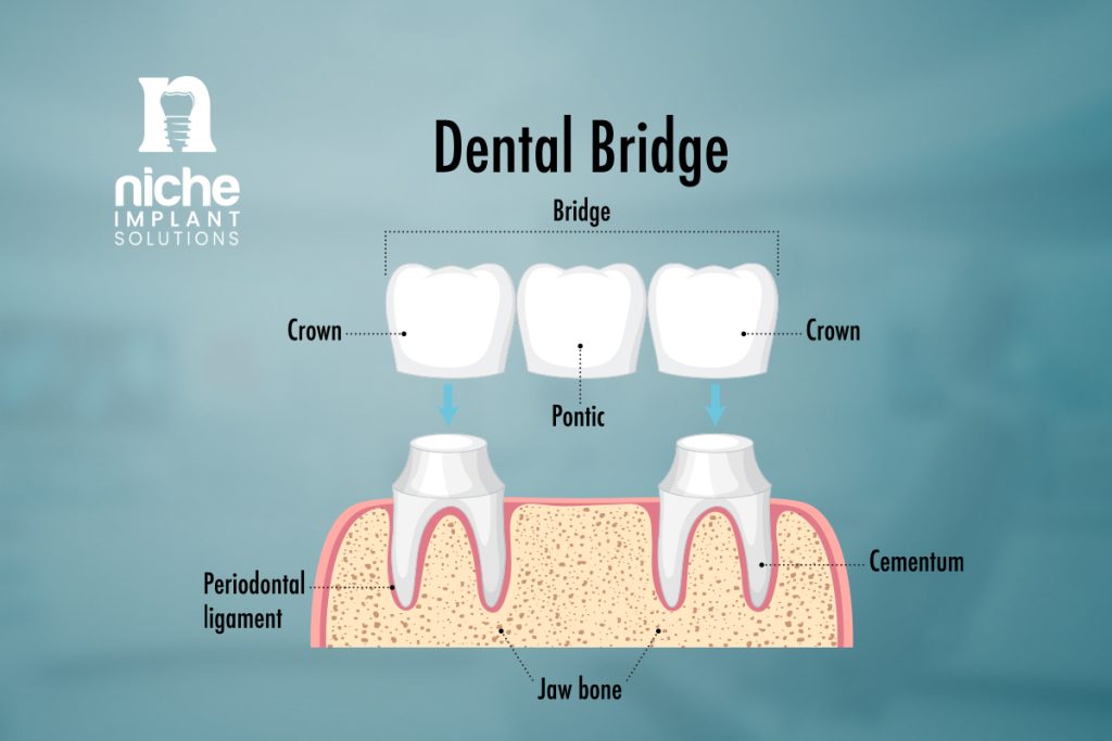 implant supported bridge