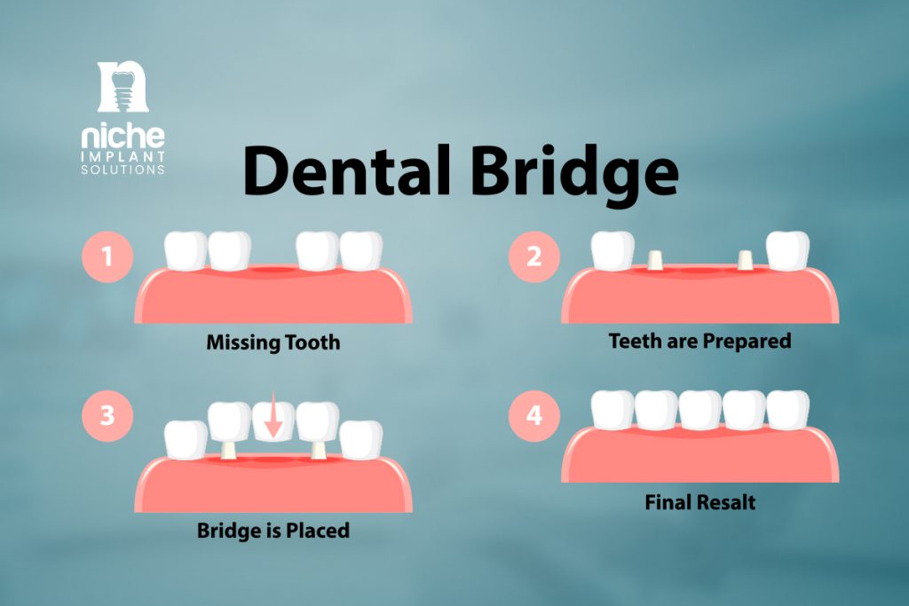 implant supported bridge