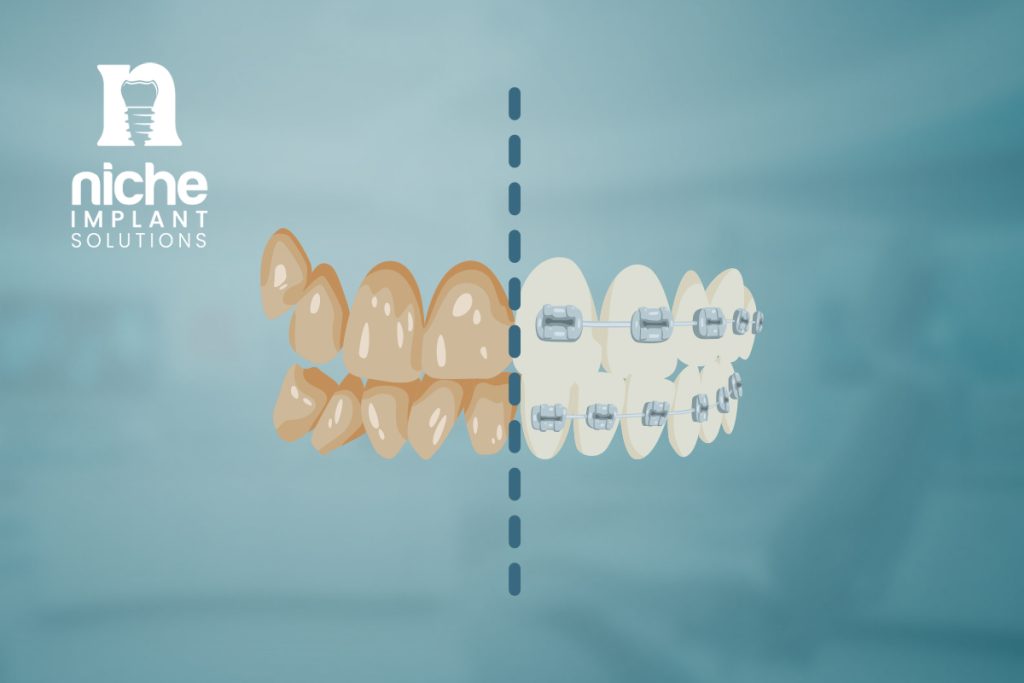 dental implant healing stages