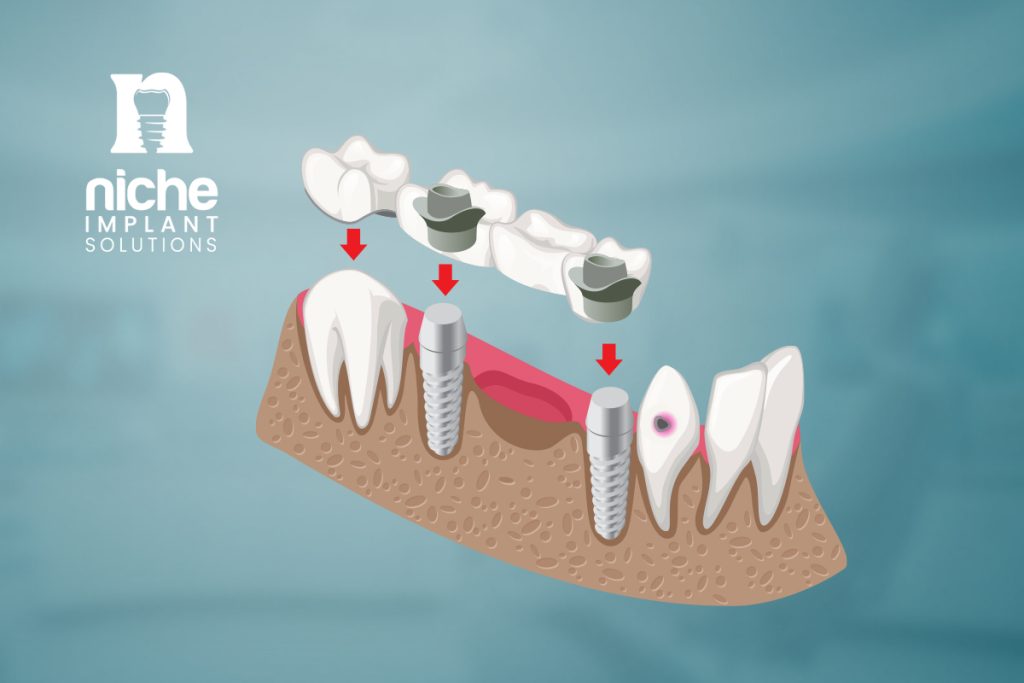 full mouth dental implants