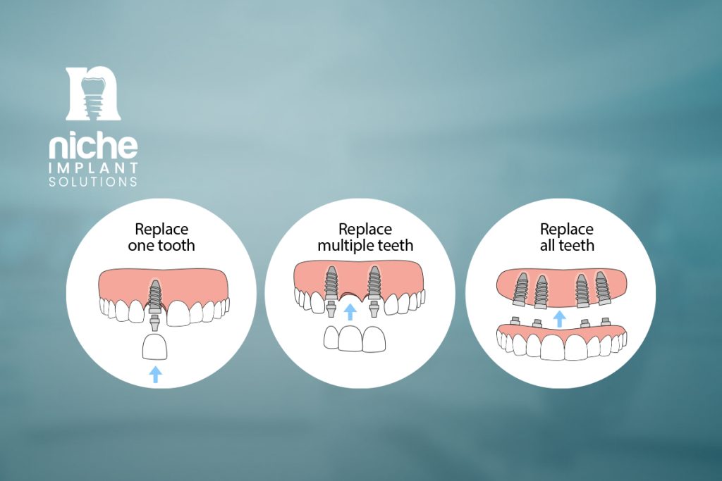 four types of dental implants