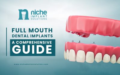 Full Mouth Dental Implant: A Comprehensive Guide