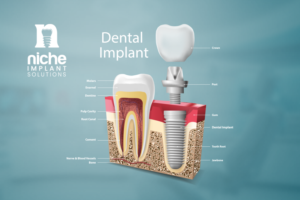 advanced implants and periodontics