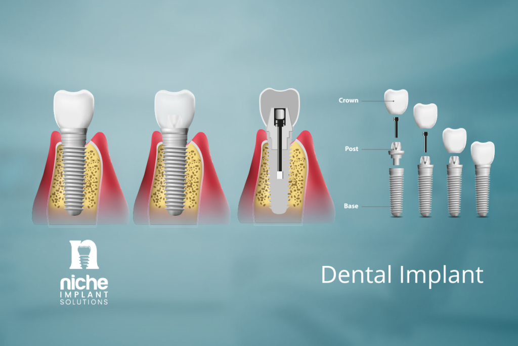 advanced implants and periodontics