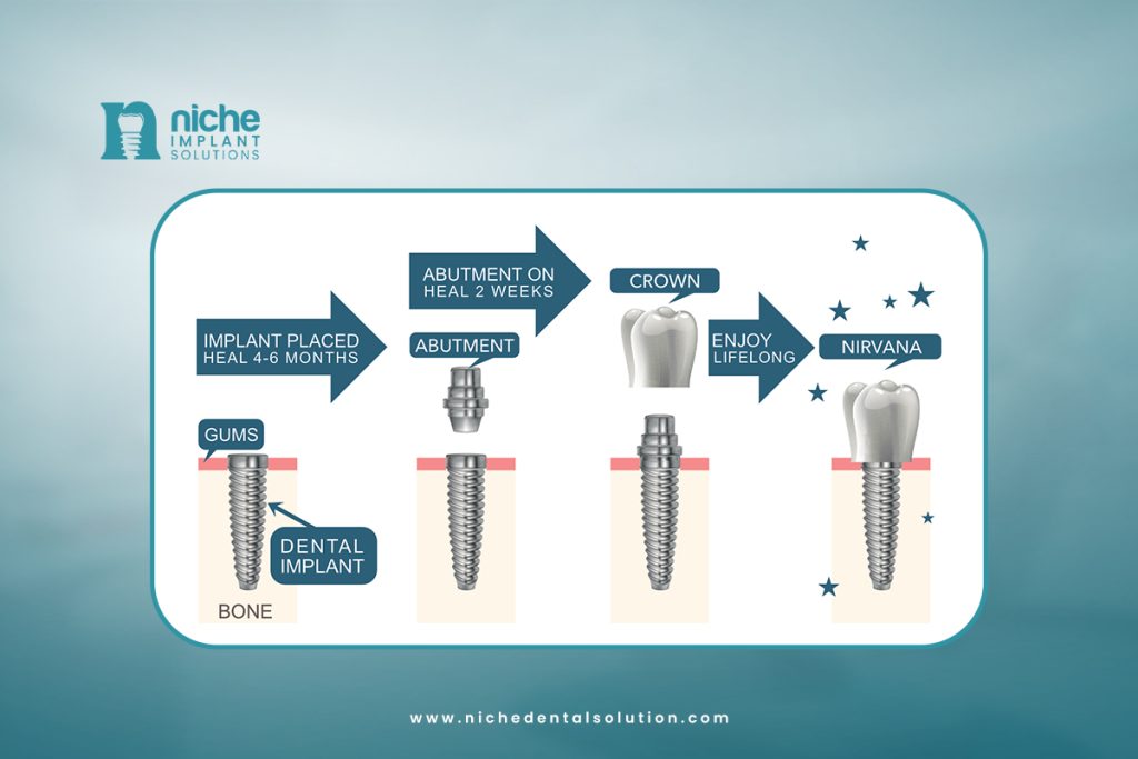 dental implant tips