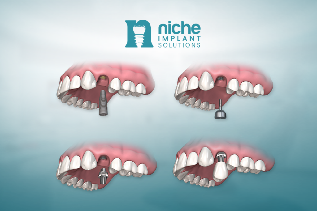 affordable dental implants