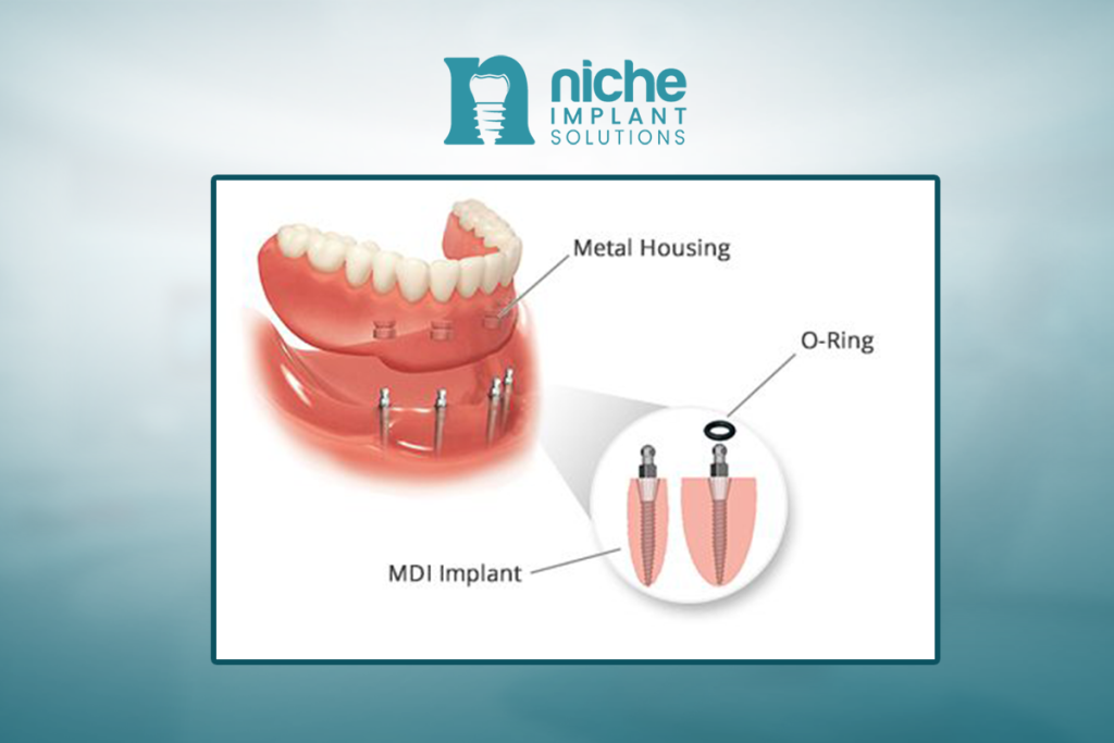 affordable dental implants