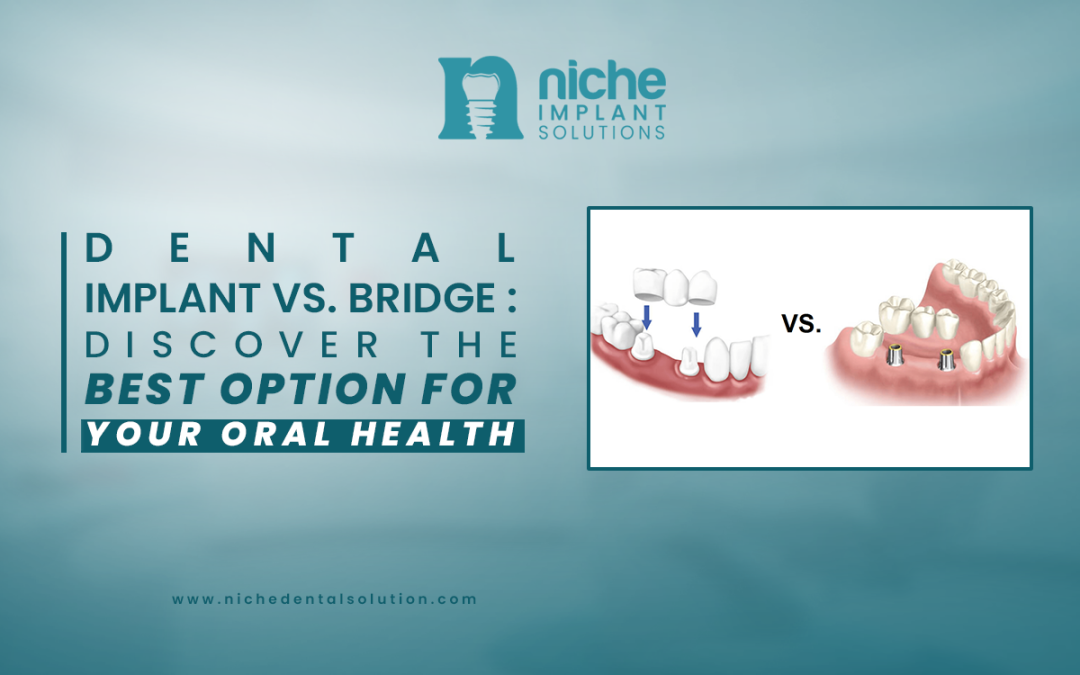 Dental implant vs. bridge : Discover the Best Option for Your Oral Health