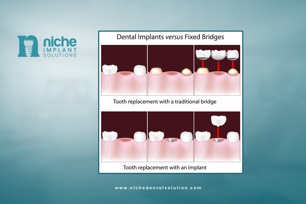 Dental implant vs. bridge