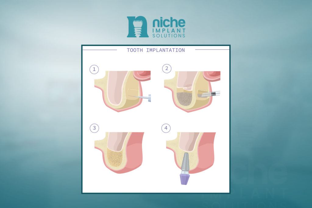 sinus lift for dental implants