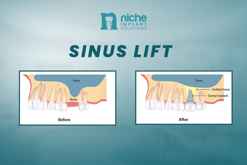 sinus lift for dental implants