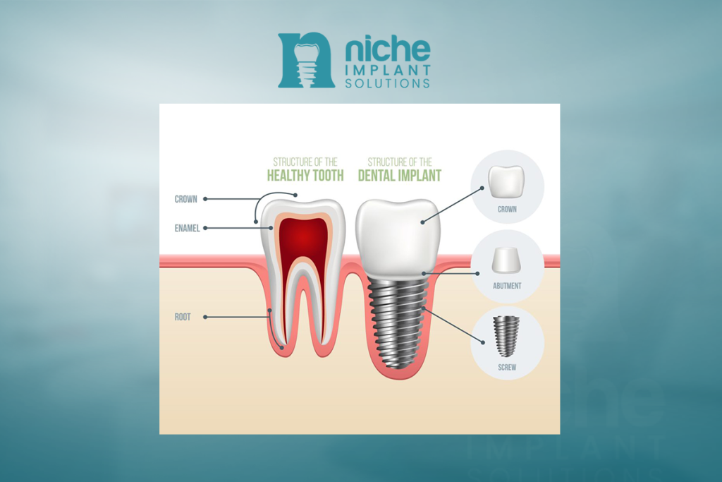 dental implant durability