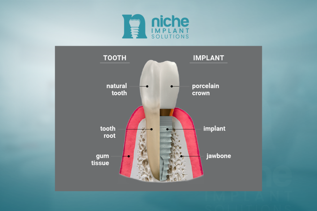 dental implant durability