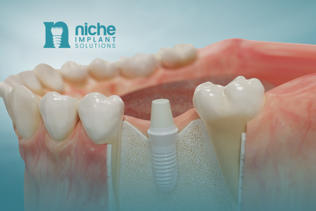 All-ceramic dental implants