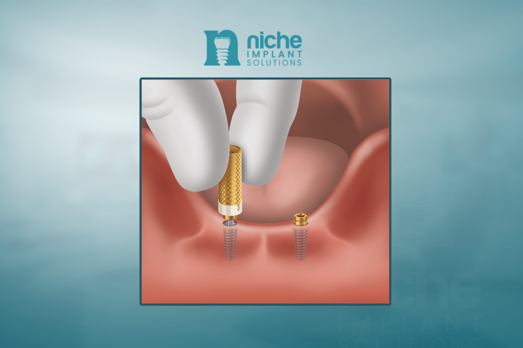 zest locator abutments